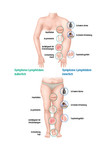 Die Symptome für ein Lymphödem
