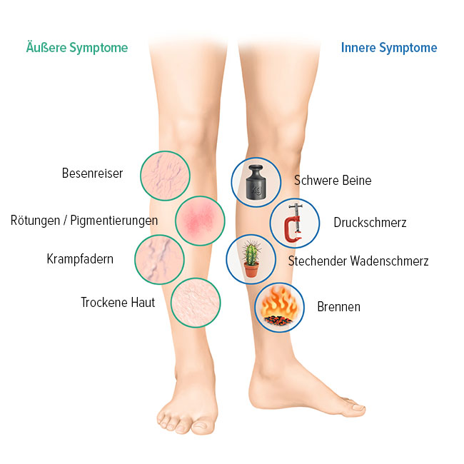 Symptome von Venenleiden