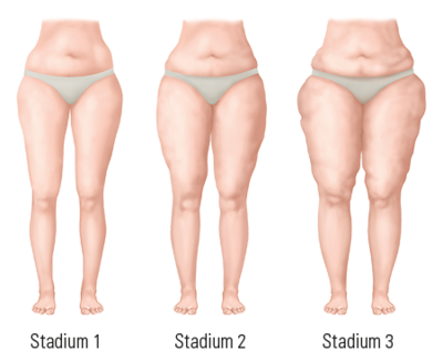 Stadieneinteilung zur morphologischen Unterscheidung