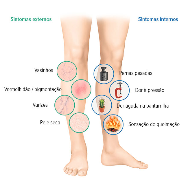 Sintomas de problemas venosos