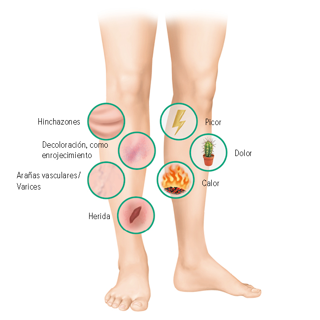 Síntomas de una pierna ulcerada Síntomas de una pierna ulcerada