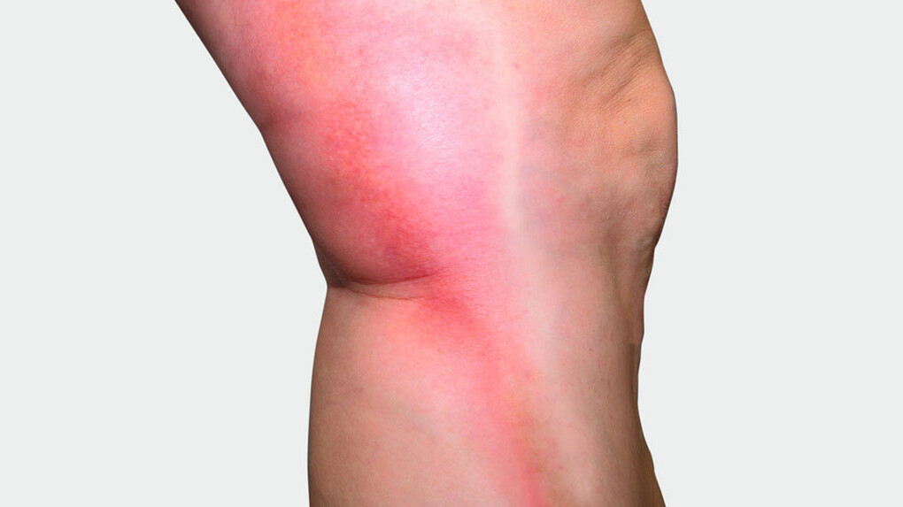 Mainteaser Ulcus cruris Beine mit Juzo Ulcer Pro
