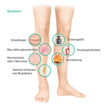 Symptome tiefe Venenthrombose