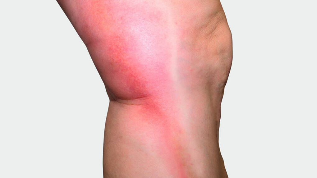 Mainteaser Thrombose Beine mit rotem Strang auf der Seite