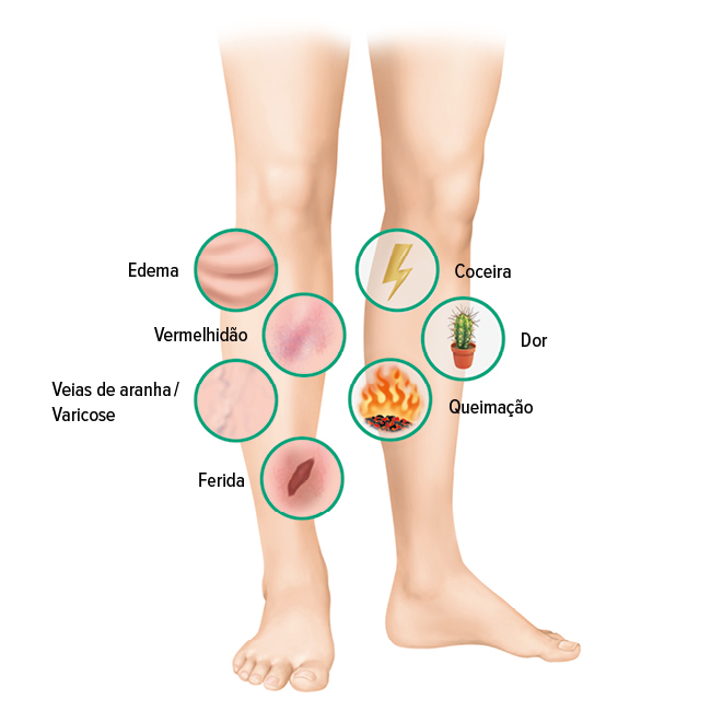 Úlcera venosa – Sintomas Úlcera venosa – Sintomas