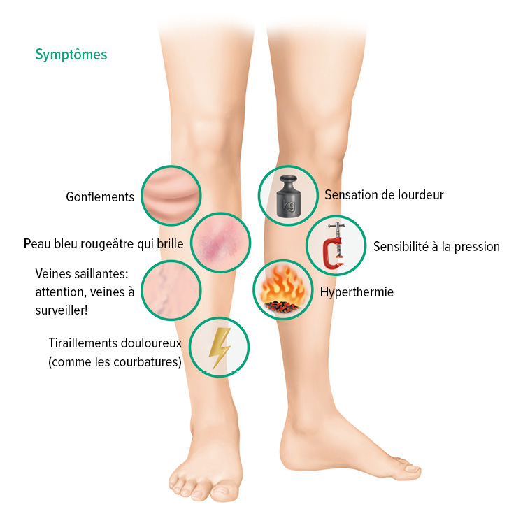 Symptômes de la thrombose veineuse profonde Symptômes de la thrombose veineuse profonde