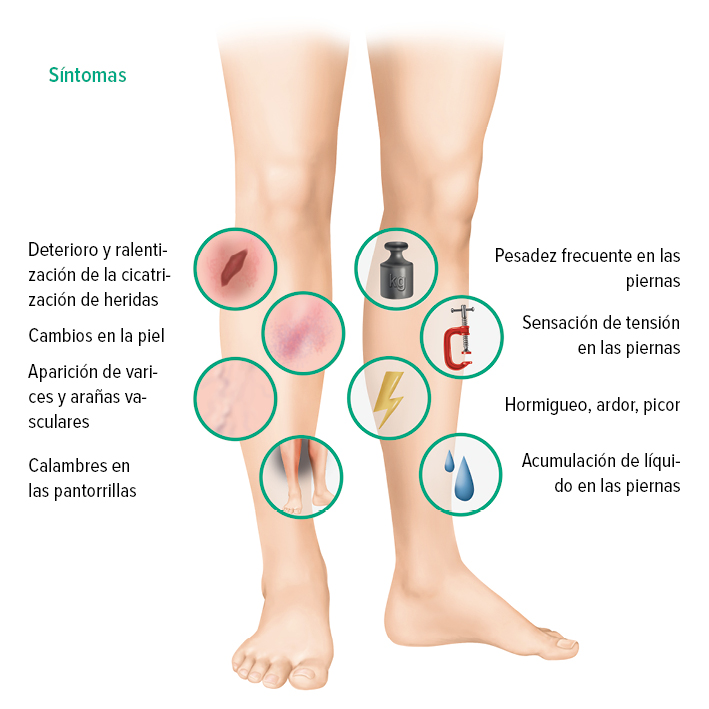 Síntomas de la IVC Síntomas de la IVC