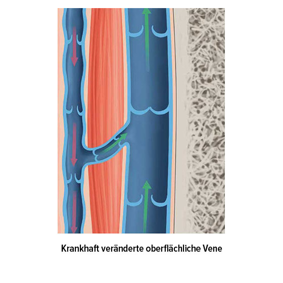 Krankhaft veränderte oberflächliche Vene Krankhaft veränderte oberflächliche Vene