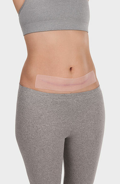 ScarPad Extra long auf einer Unterbauchnarbe bei einer Frau