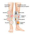 Symptômes internes et externes au niveau des jambes