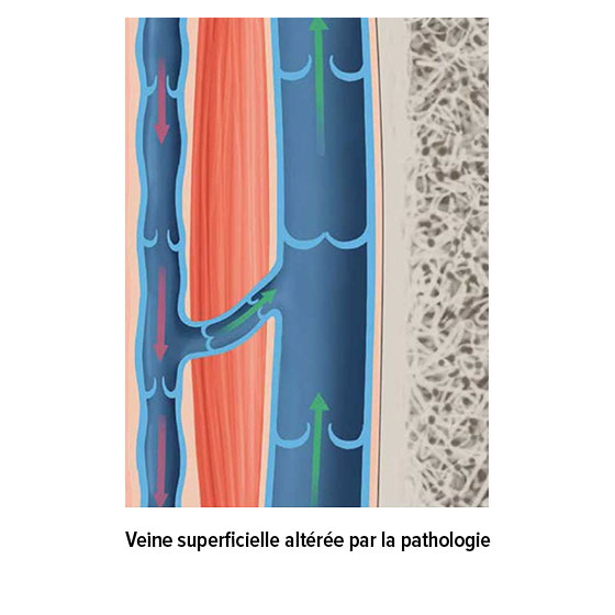 Veine superficielle altérée par la pathologie