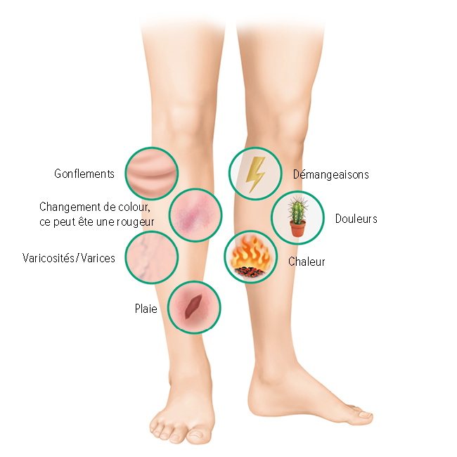 Symptômes d’un ulcère de la jambe Symptômes d’un ulcère de la jambe