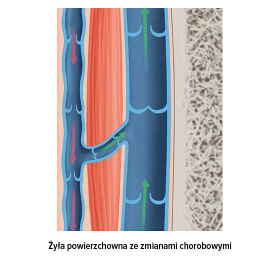 Żyła powierzchowna ze zmianami chorobowymi