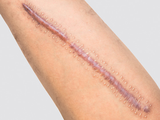 Hypertrophic scars Hypertrophic scars