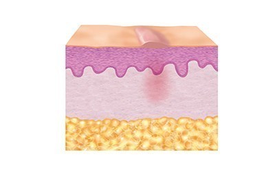 3. Repair phase (epithelisation) 3. Repair phase (epithelisation)