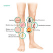 Symptoms of deep vein thrombosis