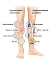 Síntomas internos y externos en las piernas