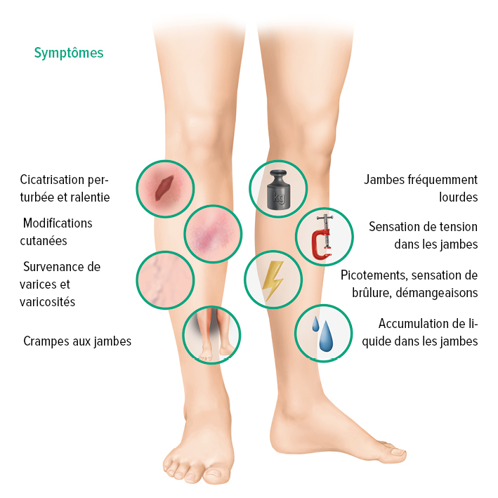 Symptômes d'un IVC Symptômes d'un IVC