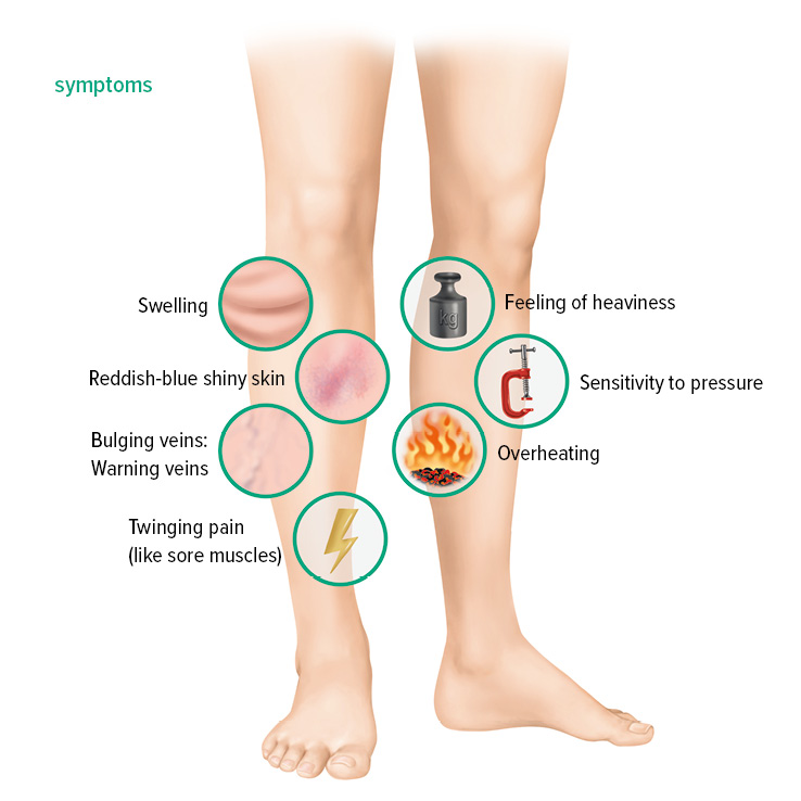 Symptoms of deep vein thrombosis Symptoms of deep vein thrombosis
