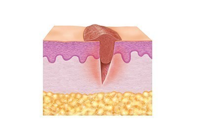 2. Granulation phase (proliferative phase) 2. Granulation phase (proliferative phase)