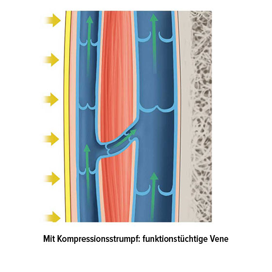 Funktionstüchtige Vene mit Kompressionsstrumpf Funktionstüchtige Vene mit Kompressionsstrumpf