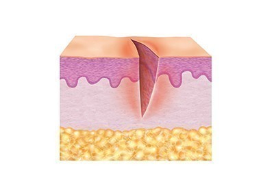 1. Cleaning phase (inflammation phase) 1. Cleaning phase (inflammation phase)