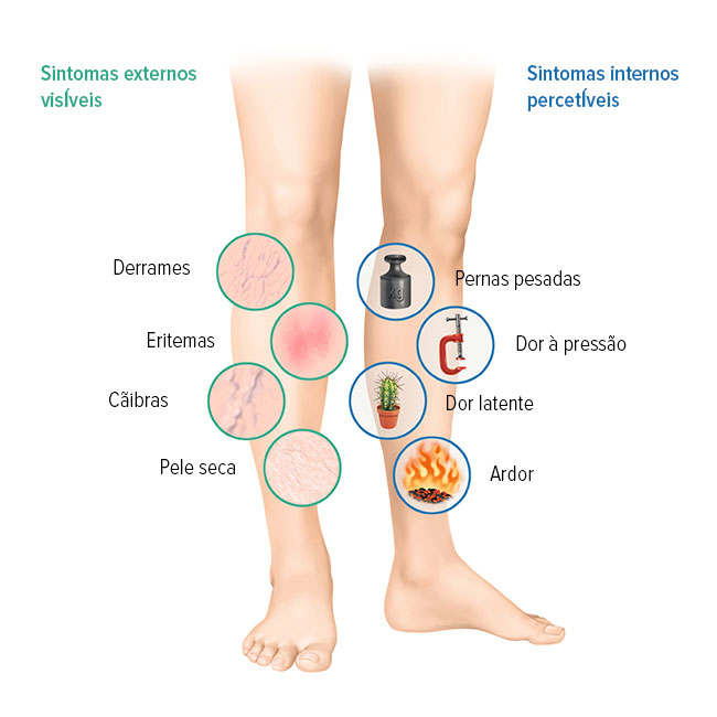 Sintomas das doenças venosas